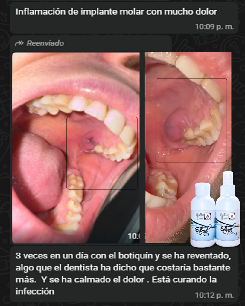 Captura de WhatsApp con foto intraoral de inflamación en implante molar y testimonio de usuaria; Kit Botiquín AyDoAgua (gel y spray)