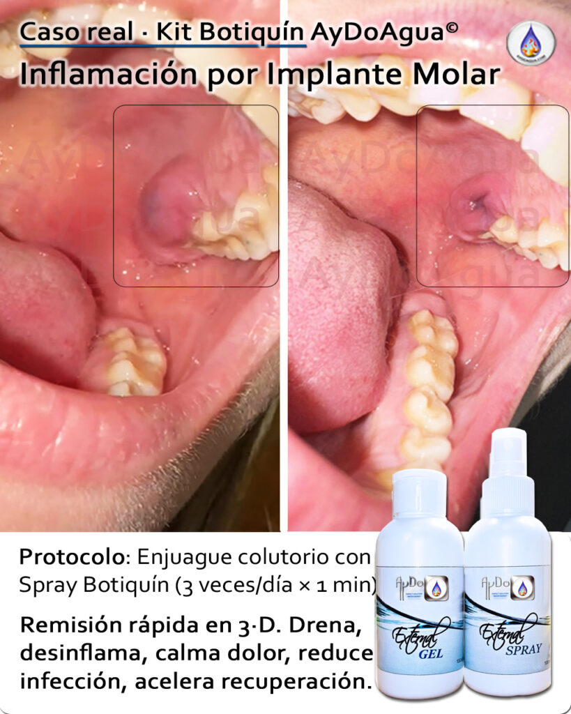 Comparativa antes/después de inflamación por implante molar con Kit Botiquín AyDoAgua; protocolo de enjuague en colutorio 3 veces/día × 1 min.